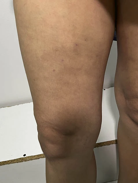 Лечение варикоза в Узбекистане Лечение варикоза в Узбекистане