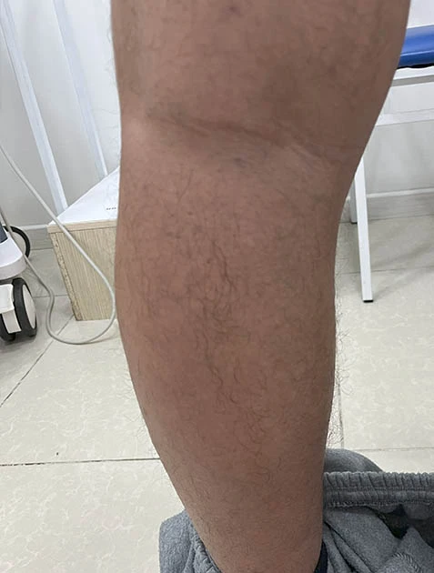 Лечение вен на ногах Лечение вен на ногах