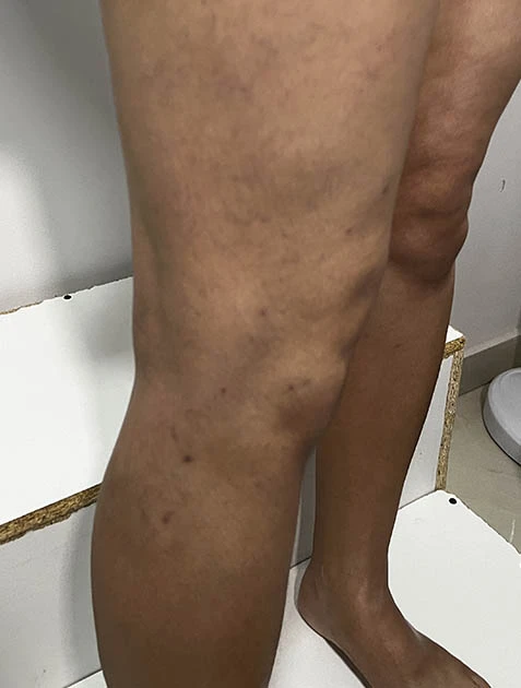 Лечение варикоза в Узбекистане Лечение варикоза в Узбекистане