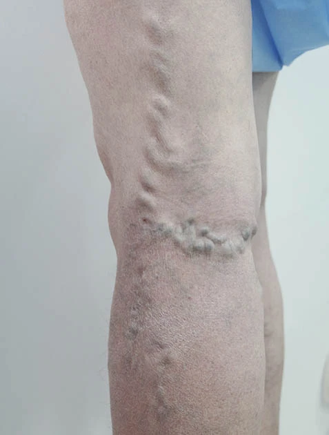 Лечение варикоза на ногах Лечение варикоза на ногах