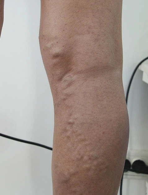 Лечение вен на ногах Лечение вен на ногах