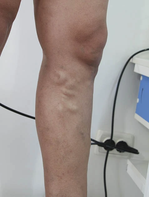 Убрать вены на ногах Убрать вены на ногах