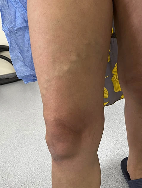 Лечение варикоза в Узбекистане Лечение варикоза в Узбекистане