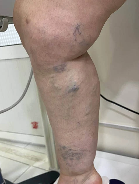 Лечение вен на ногах Лечение вен на ногах