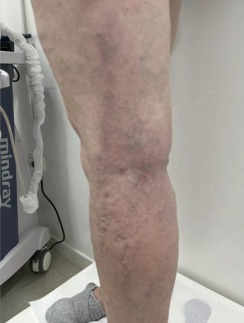 Лечение варикоза на ногах Лечение варикоза на ногах