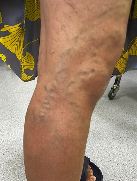 Лечение варикоза в Узбекистане Лечение варикоза в Узбекистане