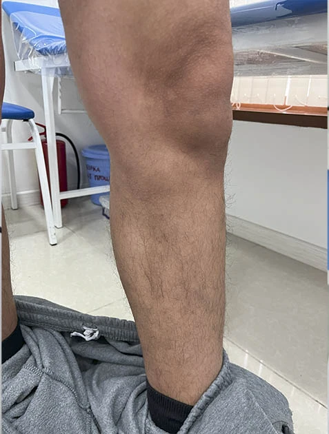 Убрать вены на ногах Убрать вены на ногах