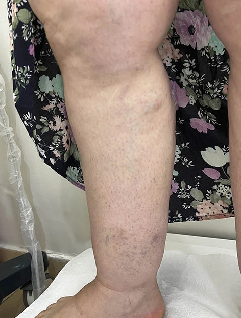 Лечение вен на ногах Лечение вен на ногах